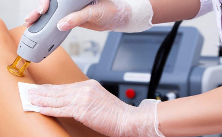  Hair removal Laser